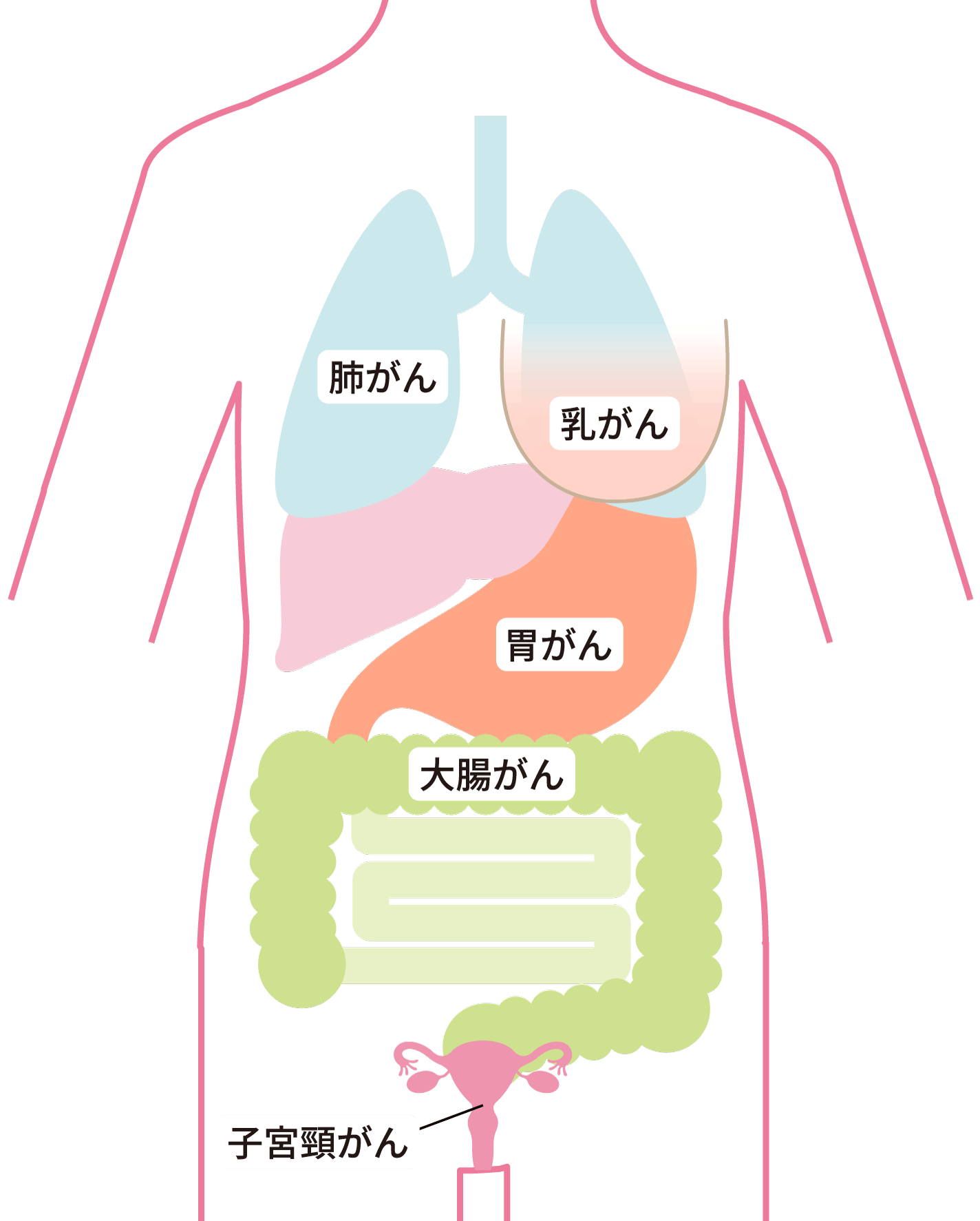 がんの部位を記した人体図